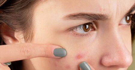 Muitas espinhas no rosto de repente? O que fazer para tratar espinhas